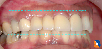 昔は銀歯、今は白い歯が保険で可能