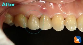 メタルを使わないセラミック