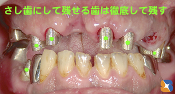 出来るだけ抜かずに残す