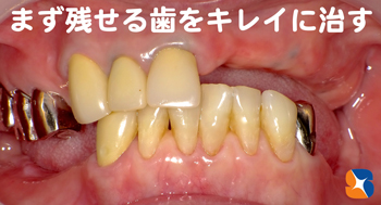 まず残っている歯を美しく