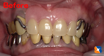 鼻の下まで延びた大きな入れ歯