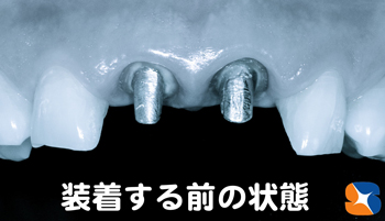 オールセラミックを装着する前の状態