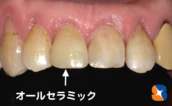 セレック導入　短期間でオールセラミック完成
