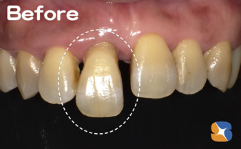 摘んで抜けそうなグラグラの前歯　