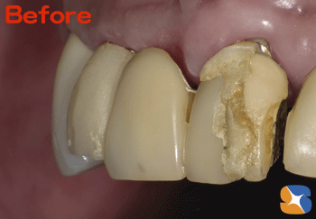 前歯　ブリッジ　保険で高品質