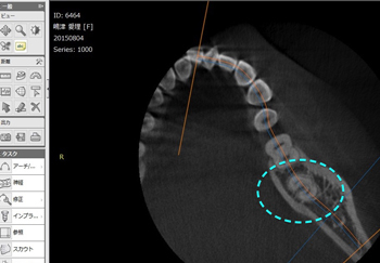 CTで親知らずを分析