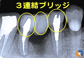 奥歯を半分にして残す