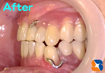 保険でよく噛める入れ歯の相談