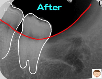 今年一番の難抜歯