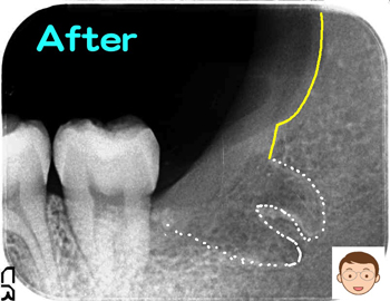 横向きの親知らずの抜歯後にテルプラグ