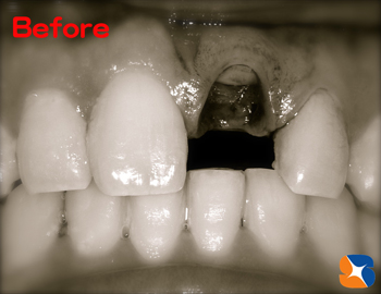 残りわずかな歯の根　残すのが難しい