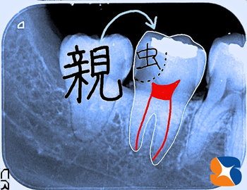親知らずの横の歯が大きな虫歯