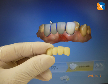 セレックでブリッジ作製