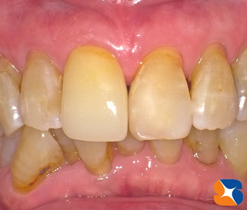 １日で前歯を完成させる