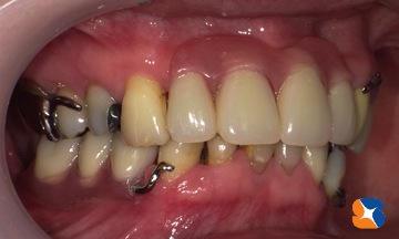 右サイドから作った入れ歯