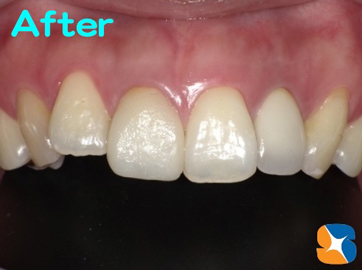 必ず満足して頂ける当院のセラミック