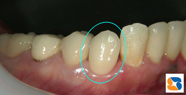 オールセラミック装着