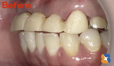 ６連結の前歯のブリッジ　保険でも丁寧に作る