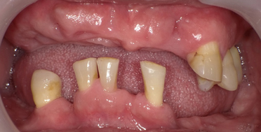 残せる歯は全力で残す