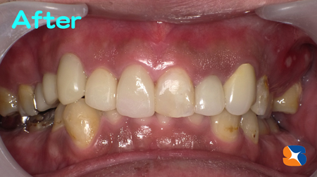 保険で白い被せを入れれる所は保険を使う