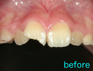 事故　前歯　割れる　痛む