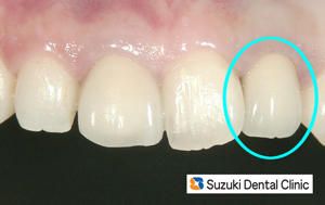 前歯　セラミックの被せ　
