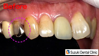 保険の銀歯、高額のセラミック、に代わる第３の白い歯