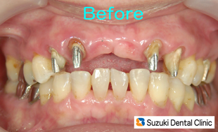 自分の歯４本で、６本分の歯を支える