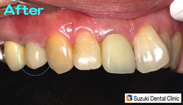 保険の銀歯、高額のセラミック、に代わる第３の白い歯