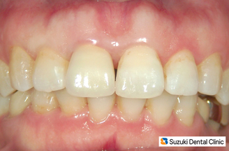 オールセラミックが入ったところ