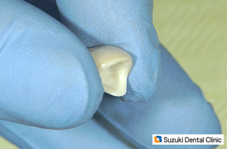 メタルを使わないセラミック