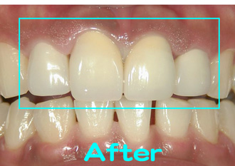 保険　自然感のある前歯