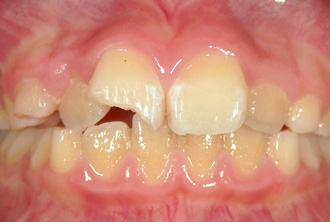 事故　前歯　欠ける