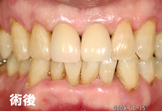 新しいセラミックのかぶせ物