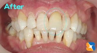 ホワイトニング後にセラミックを換える
