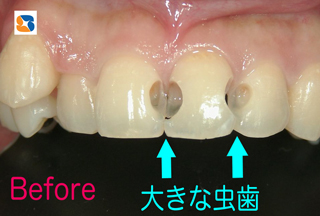 神経に近い大きな虫歯