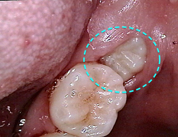 ビデオカメラで親知らずを撮影