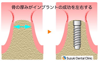 骨を強くしてからインプラントに取り組む