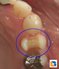 オールセラミックの詰め物