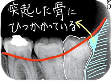 親知らずを局部的なレントゲンで撮影