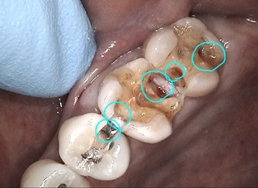 最も見えにくい上の奥歯もビデオで確認