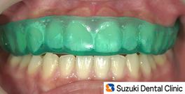 マウスピース／マウスガード