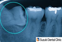 抜歯前：斜めに生えた親知らず