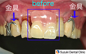 旧入れ歯の改善点