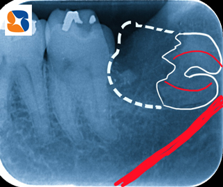 残りの部分も折れ曲がり引っ掛る