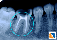 神経を抜いた後に薬を詰める