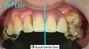 鈴木歯科医院の保険の入れ歯