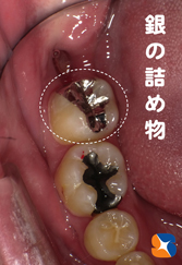同時進行：横向きの親知らずの抜歯と虫歯の治療