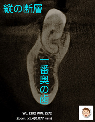 歯を縦に割って診断する