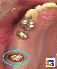 しっかりした移植歯